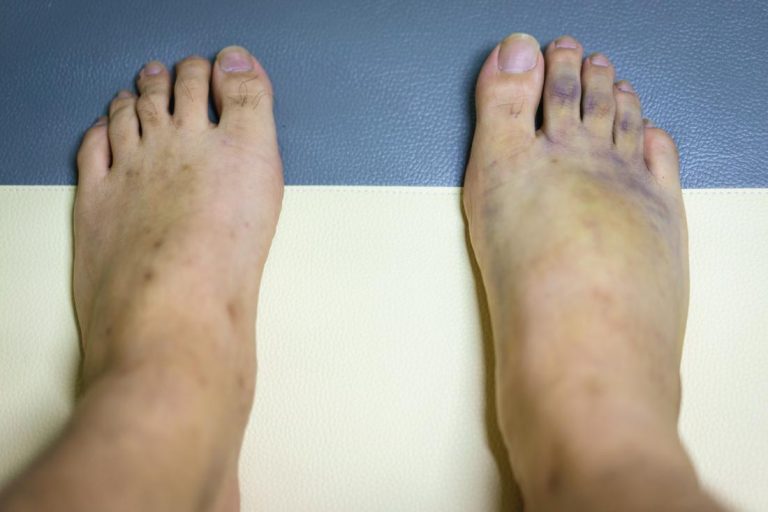 Fading Marks: Exploring the Possibility of Discoloration on Legs Disappearing